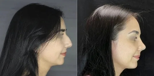 Antes y después de rinoplastía, vista de perfil, Dra. Claudia Navarrete