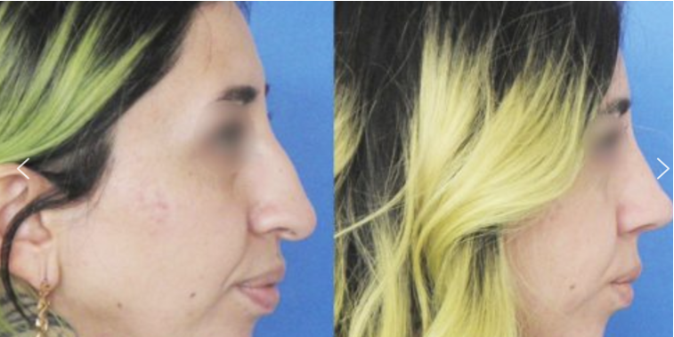 Antes y después de cirugía nasal con la Dra. Claudia Navarrete
