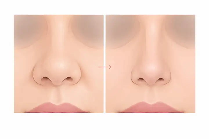 Ilustración: reducción de la punta nasal