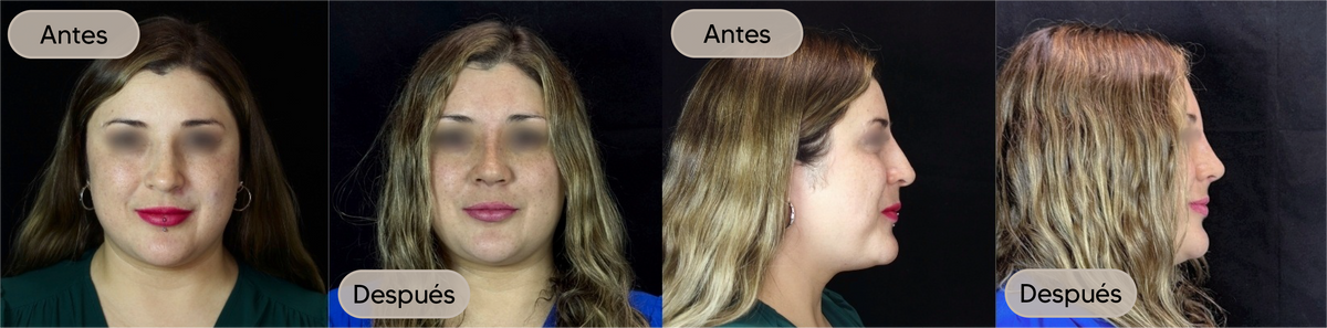 Antes y después, vista frontal, caso 5 — Dra. Claudia Navarrete