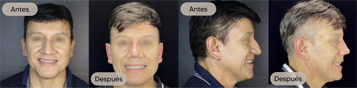 Antes y después, vista frontal, caso 7 — Dra. Claudia Navarrete