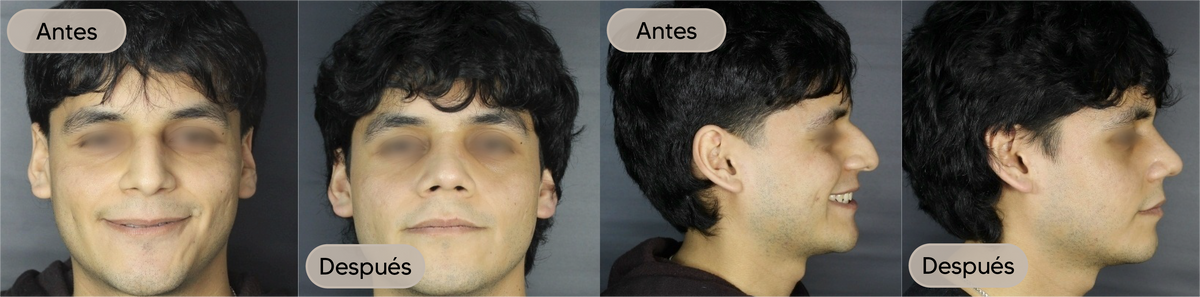 Antes y después, vista frontal, caso 2 — Dra. Claudia Navarrete