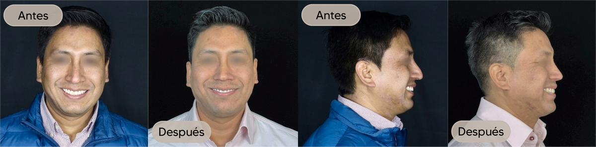 Antes y después, vista frontal, caso 4 — Dra. Claudia Navarrete
