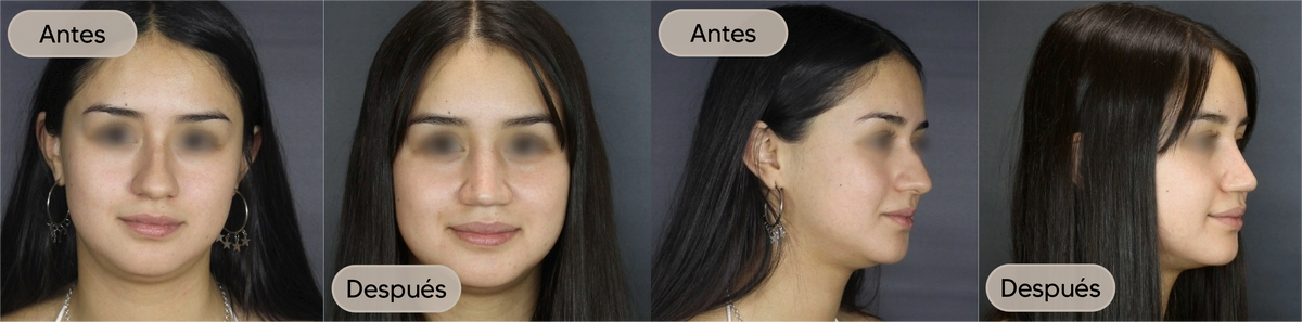 Antes y después, vista frontal, caso 3 — Dra. Claudia Navarrete
