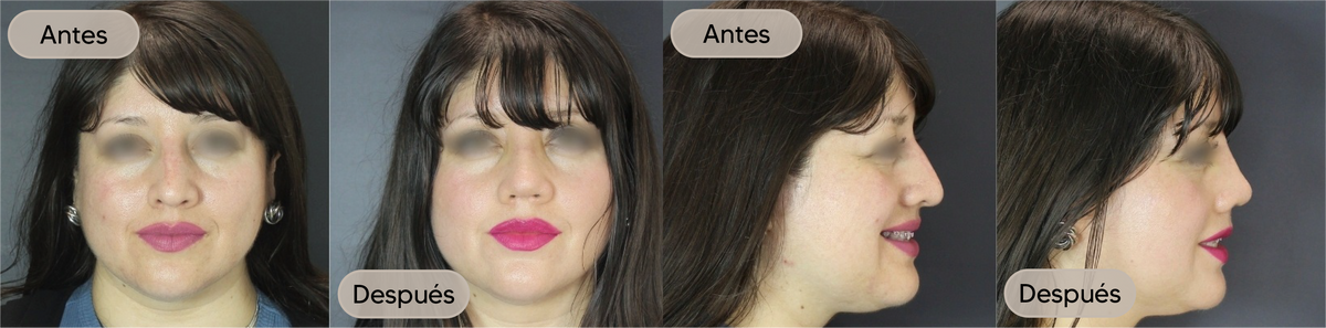 Antes y después, vista frontal, caso 8 — Dra. Claudia Navarrete