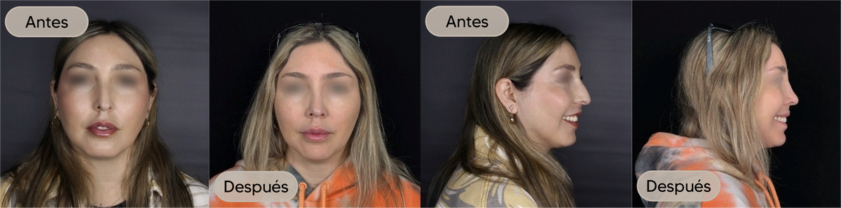 Antes y después, vista frontal, caso 1 — Dra. Claudia Navarrete