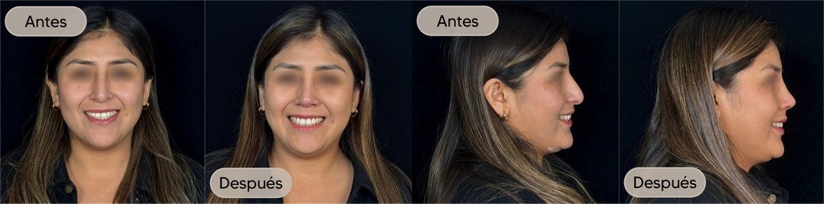 Antes y después, vista frontal, caso 6 — Dra. Claudia Navarrete