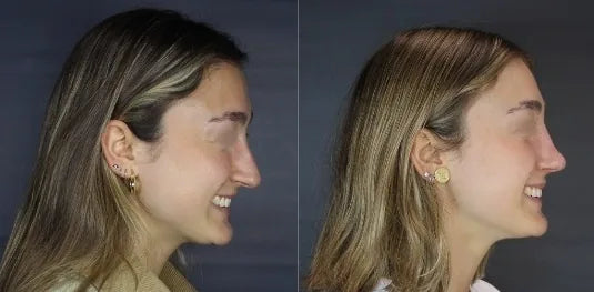 Antes y después de rinoplastía, vista de perfil, Dra. Claudia Navarrete