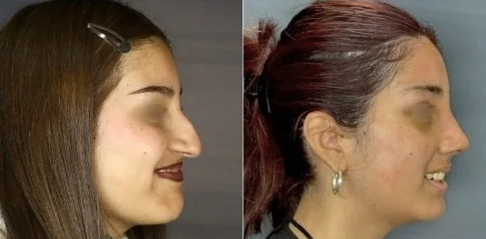 Antes y después de rinoplastía, vista de perfil, Dra. Claudia Navarrete
